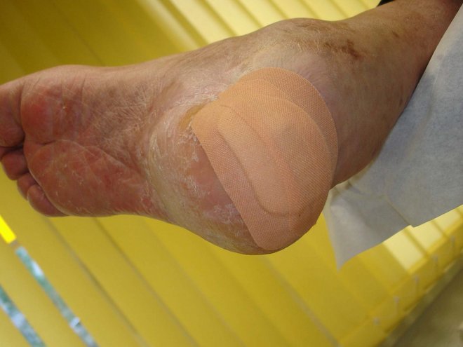 Ferse nach der Behandlung: die Wunde ist abgedeckt, darüber sitzt eine zusätzliche Fixation zur Druckentlastung.